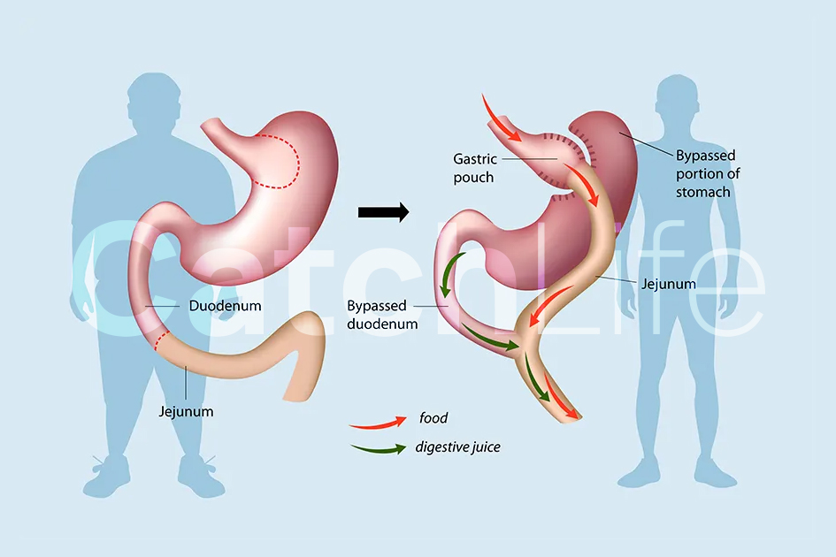 What is Gastric Bypass?